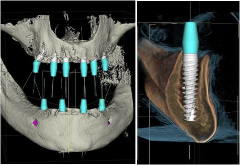 Tomografie dentară a masivului facial, cu secțiuni tridimensionale ale maxilarelor