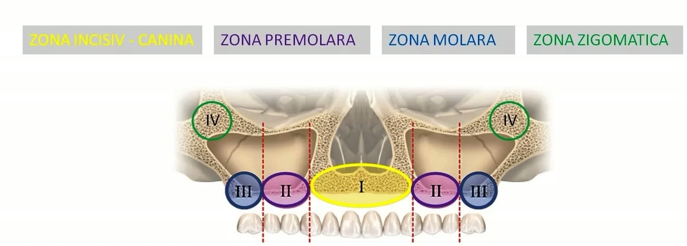 Schemă cu zonele de os ale maxilarului superior: zona I incisiv-canină, zona II premolară, zona III molară și zona IV zigomatică