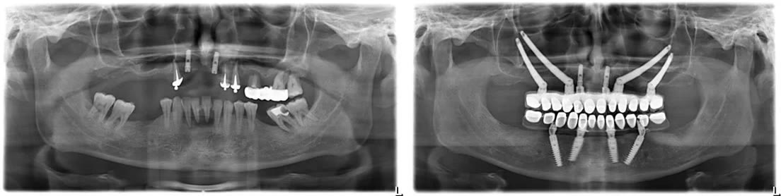 Radiografii panoramice comparate: situația inițială și rezultatul cu implanturi zigomatice și lucrare fixă totală
