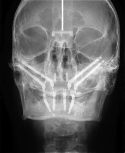 Radiografie frontală a craniului cu patru implanturi zigomatice ancorate în pomeți