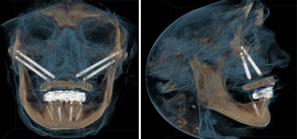 Reconstrucții tomografice 3D, din față și din profil, cu implanturile zigomatice și lucrarea fixă totală