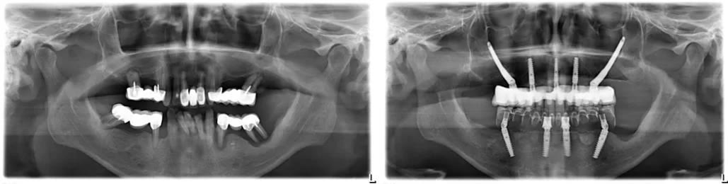 Radiografii panoramice înainte și după: dinți restanți compromiși, apoi implanturi zigomatice și convenționale cu lucrare fixă