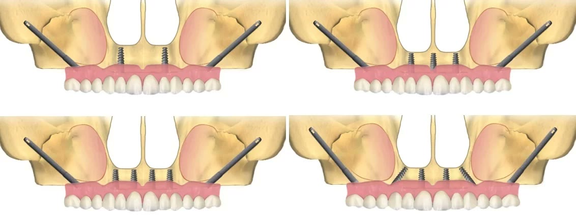 Patru variante 3D de TotalFix+: implanturi zigomatice posterioare combinate cu 2, 3 sau 4 implanturi convenționale anterioare