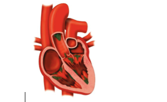 Ce este îngroșarea valvelor inimii?